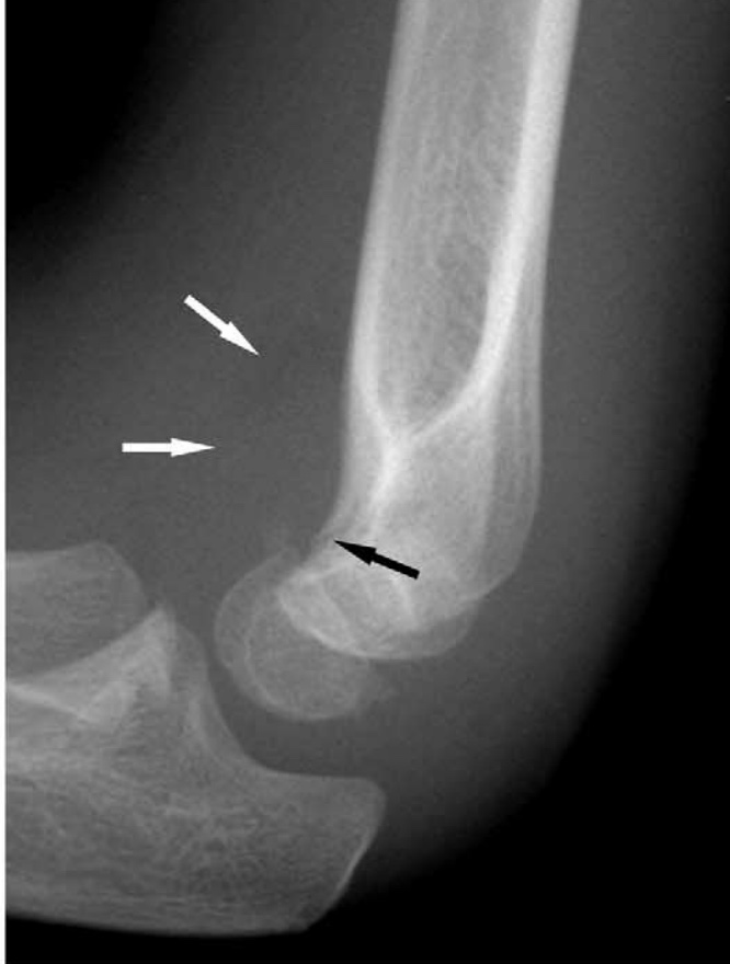 Elbow X Ray Fracture 6974
